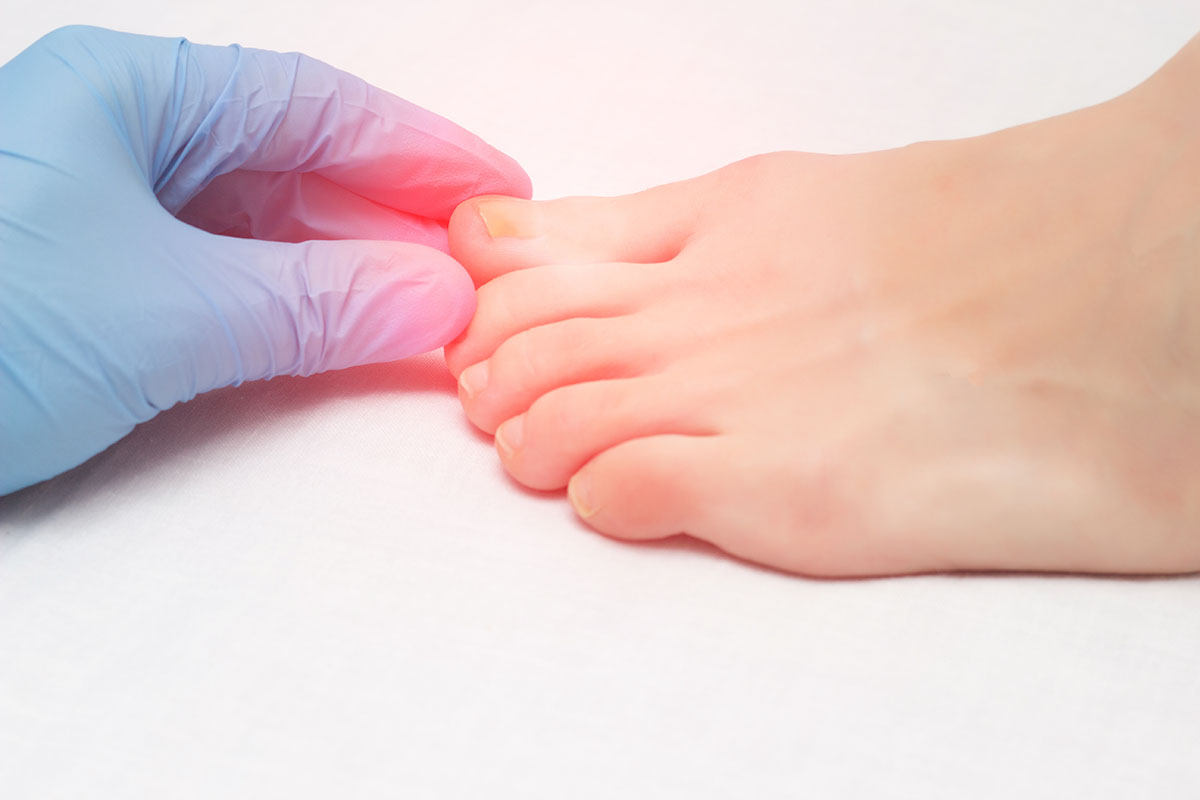 Doctor examines a sore toe infected with fungal infection, close-up, onychomycosis, infection